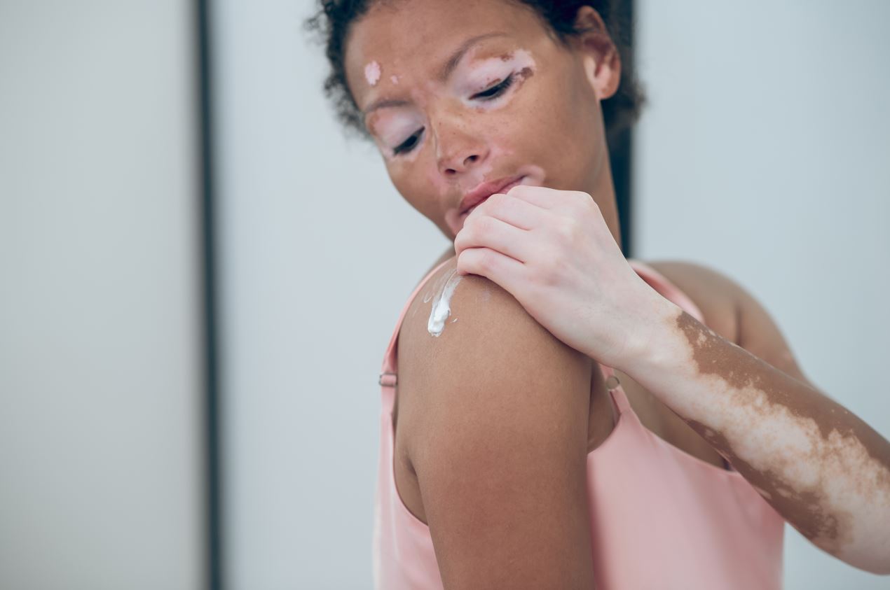 Des actus (positives) : Une crème contre le vitiligo ; Comment ...